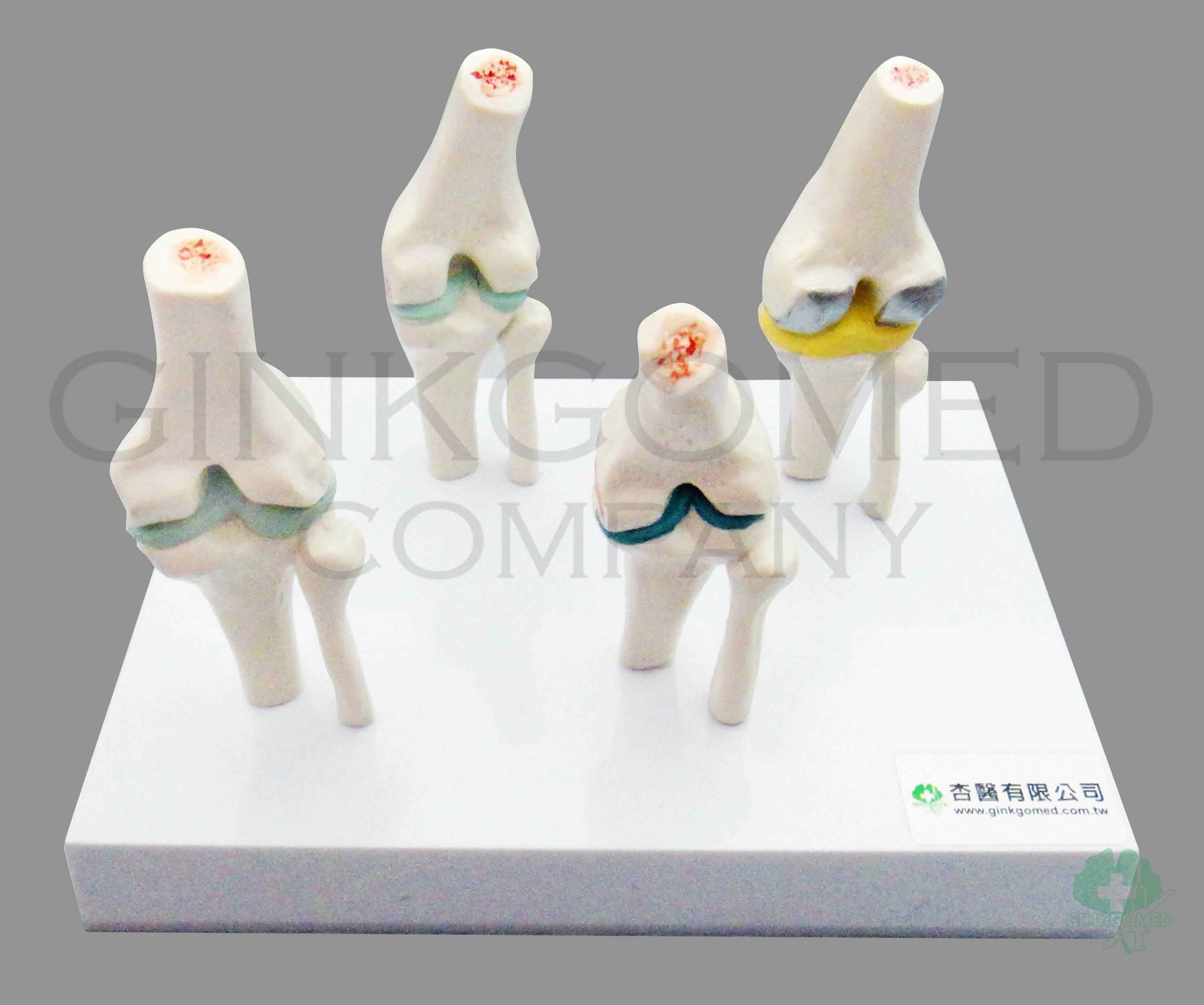 GM-100005  Healthy and Diseased Knee Joints