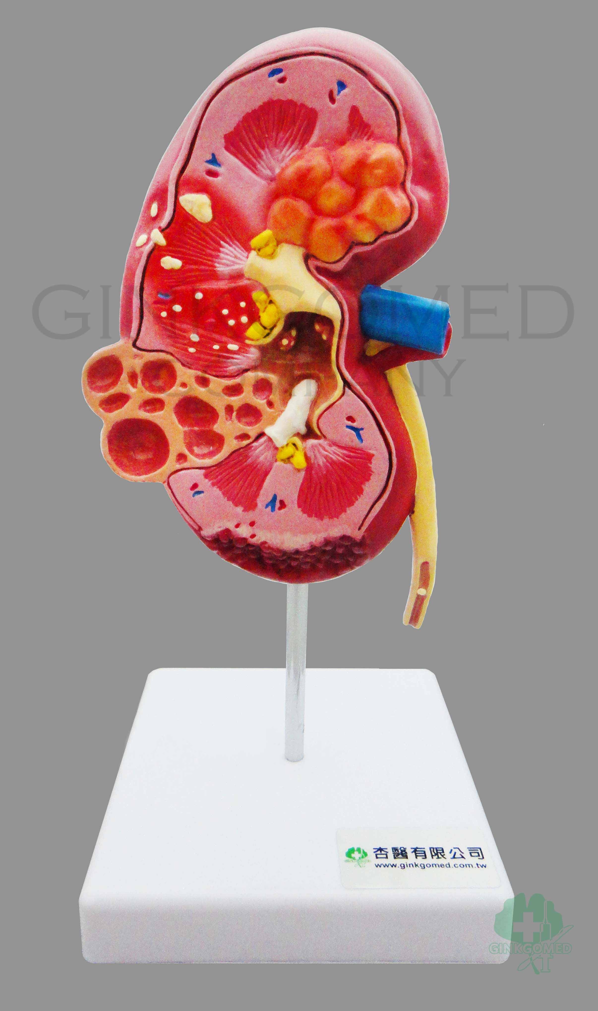 GM-100011  Diseased Kidney