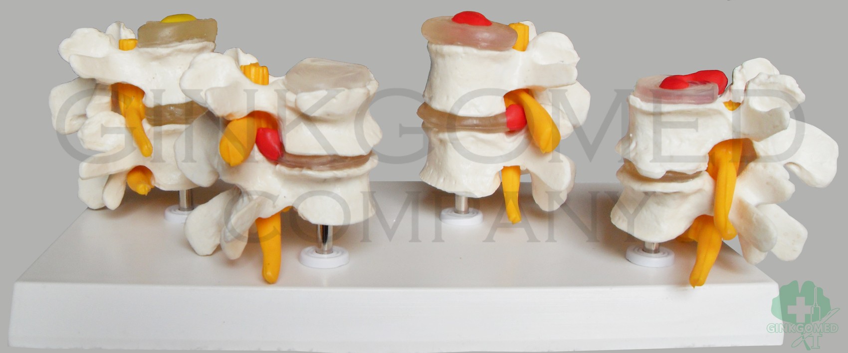 GM-100014  Healthy and Diseased Lumbar Joints