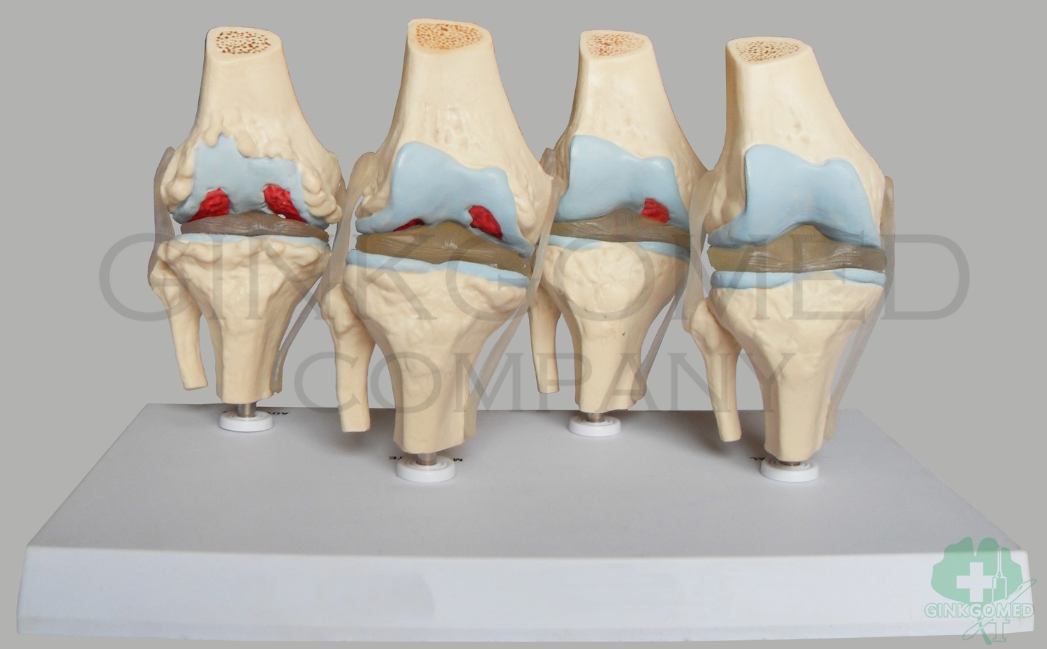 GM-100015  Disease Progress of Knee Joint