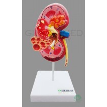 GM-100011  Diseased Kidney