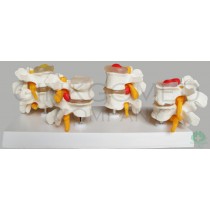 GM-100014  Healthy and Diseased Lumbar Joints