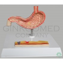 GM-100016  Diseased Stomach